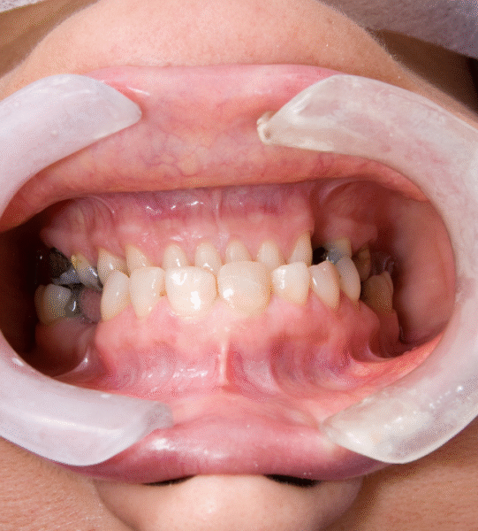 Full Mouth Rehabilitation