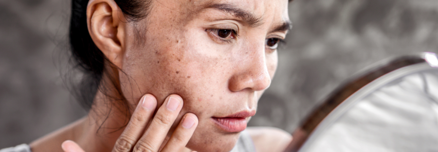 Melasma