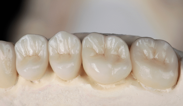 Dental Crowns & Tooth Bridges in Jaipur | Swez Dental Clinic