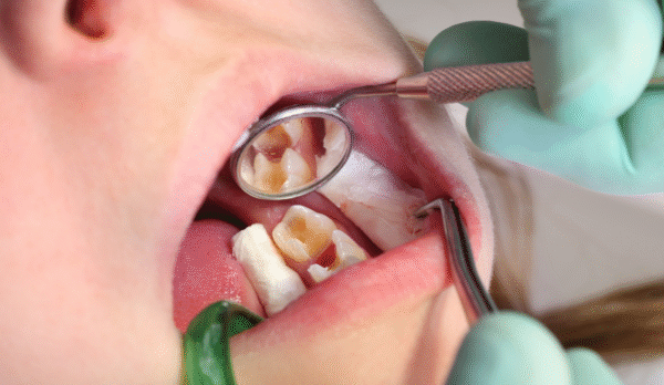Dental Filling Services in Jaipur | Swez Dental Clinic