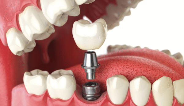 Dental Implant Solutions in Jaipur | Swez Dental Clinic