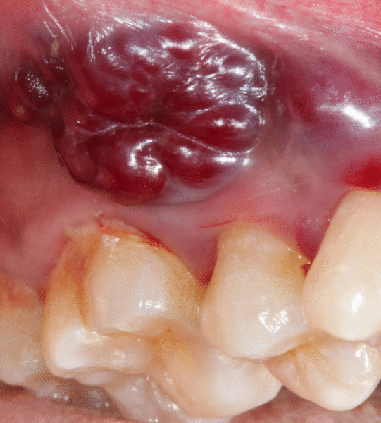 Oral Cancer Diagnosis in Jaipur | Swez Dental Clinic