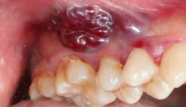 Oral Cancer Diagnosis in Jaipur | Swez Dental Clinic