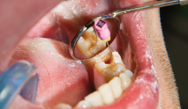 Root Canal Treatment in Jaipur | Swez Dental Clinic