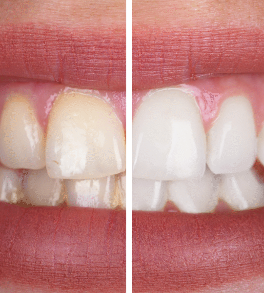 Tooth Whitening